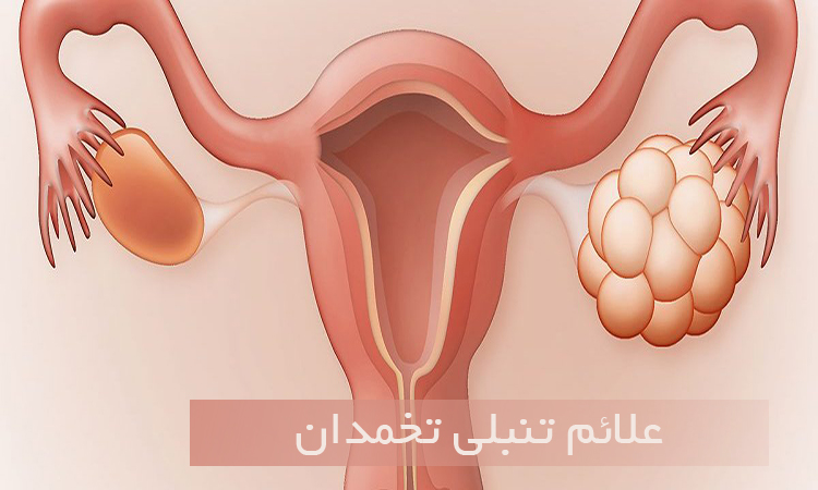 تنبلی تخمدان