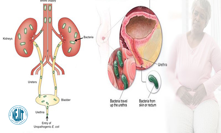 علت عفونت ادراری