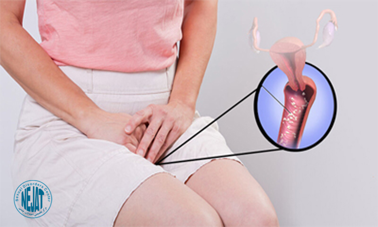 بهترین راه پیشگیری از عفونت قارچی واژن