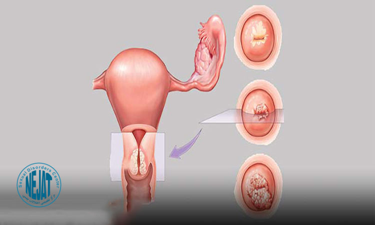 آسیب دیدگی دهانه رحم از عوارض کورتاژ کردن