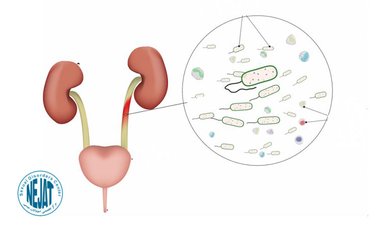 علائم عفونت ادراری