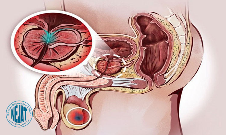 سرطان آلت تناسلی مردان