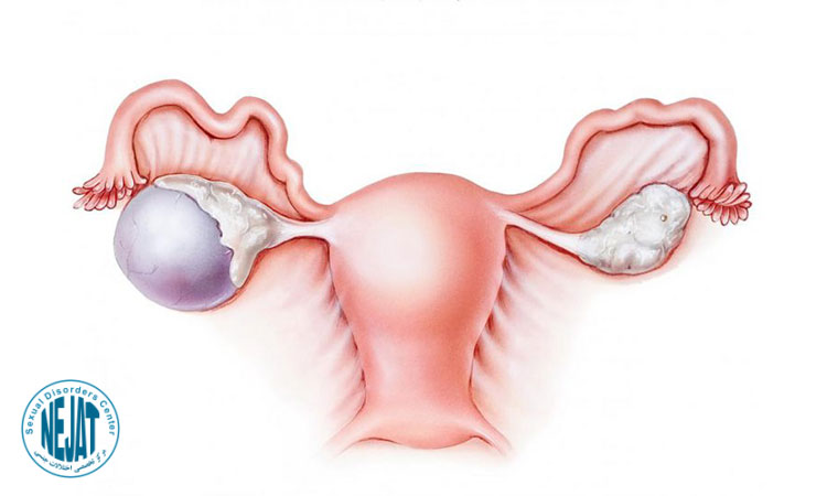انواع کیست تخمدان