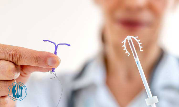 iud چیست؟