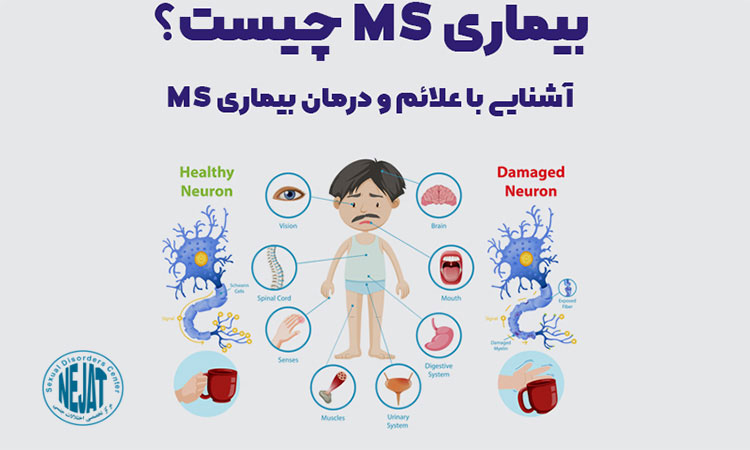 علائم بیماری ام اس