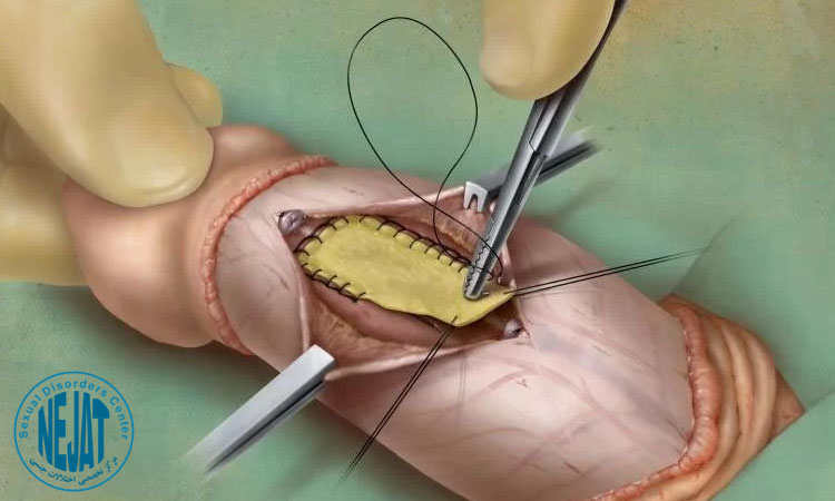 عمل جراحی جهت درمان پیرونی