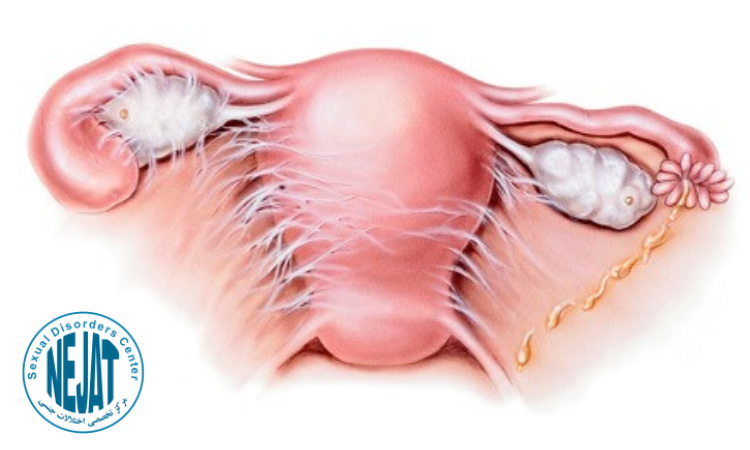 چسبندگی رحم