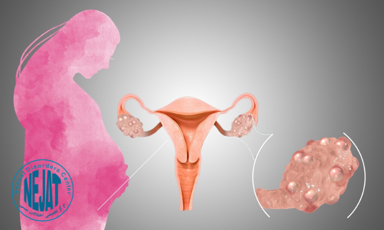 تأثیر تنبلی تخمدان بر بارداری