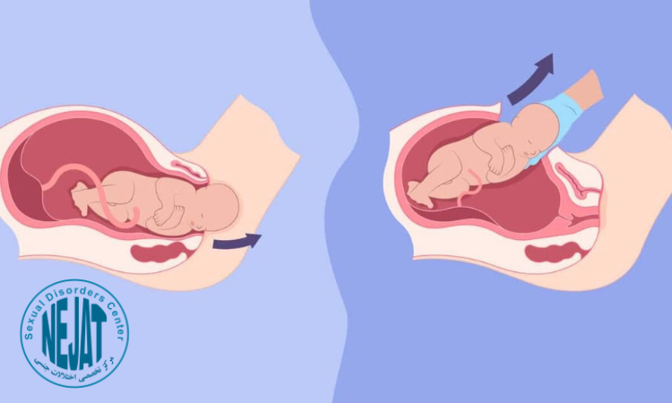 تفاوت زایمان طبیعی و سزارین